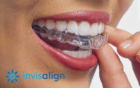 Invisalign Cost Breakdown: What to Expect Without Insurance